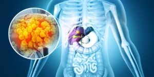 cancer representation due to alcohol use